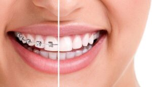 teeth whitening