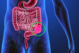 How to deal with constipation?