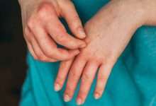Eczema Conditions and signsymptom