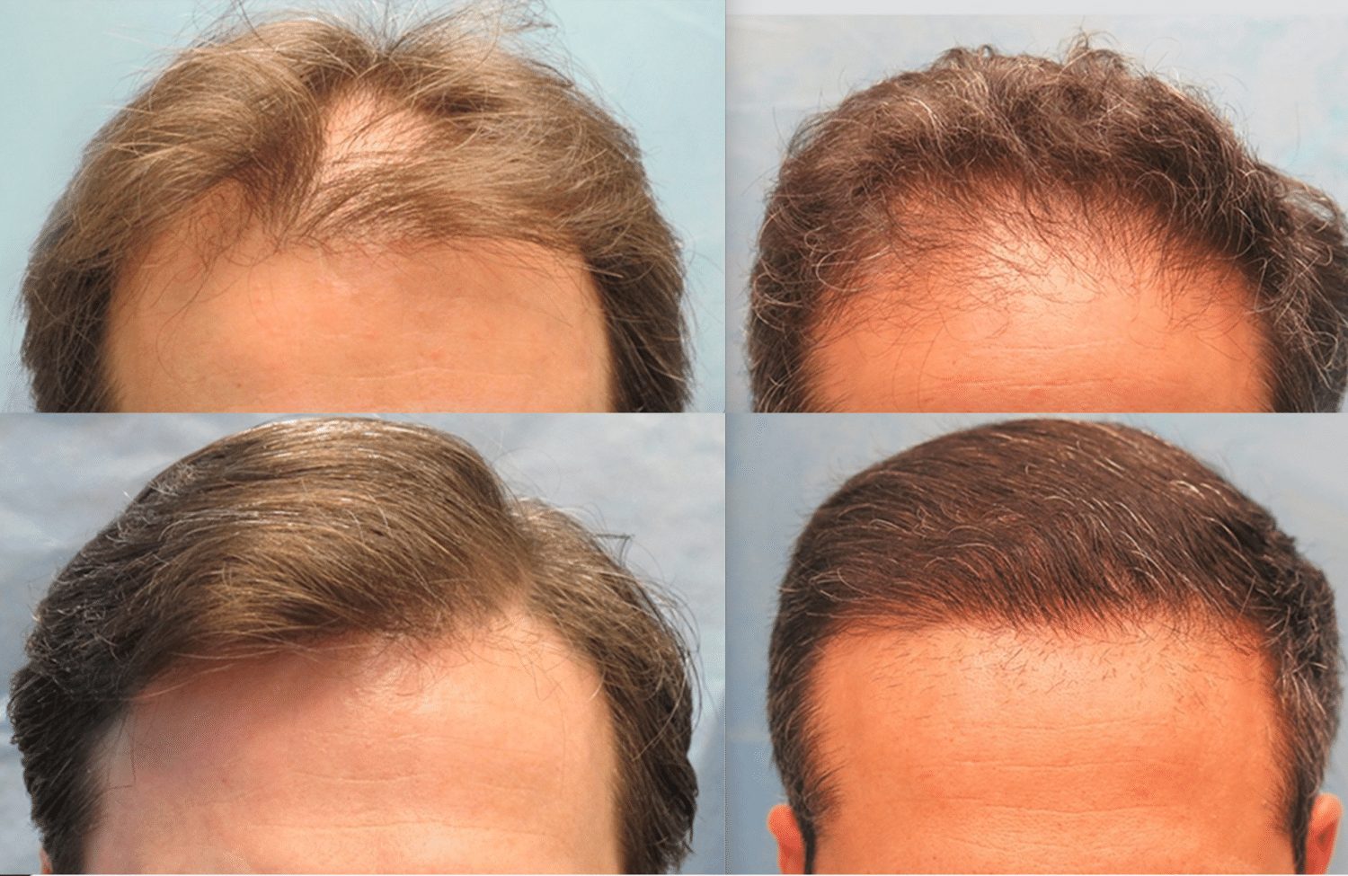 hair transplant - FUE Hair Transplant
