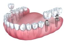 dental implants greenwood