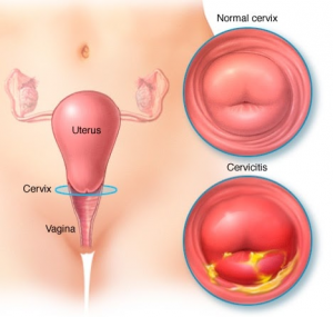 Below is a picture displaying the difference between a healthy cervix and a cervix with cervicitis.