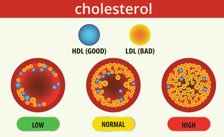 high cholesterol symptoms