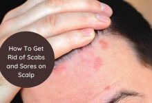 How To Get Rid of Scabs and Sores on Scalp
