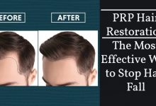 prp for hair loss- PRP Hair Restoration- The Most Useful Way to Stop Hair Fall