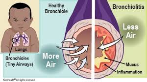 A Bronchitis Recipe That Removes Phlegm from the Lungs and Cures Bronchitis Immediately