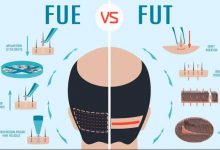 fue vs fut- FUT Vs FUE Hair Transplant- Which one is most Beneficial?