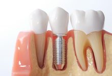 what are dental implants made of