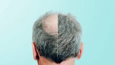 Why You Should Choose Laser Treatment Instead of Hair Transplant