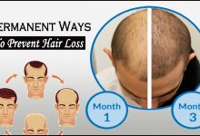 prevent hair loss- Permanent Ways to Prevent Hair Loss