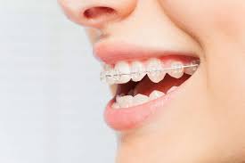 Teeth straightening