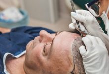 What Are The Major Advantages of FUT+FUE+BHT Hair Transplant?