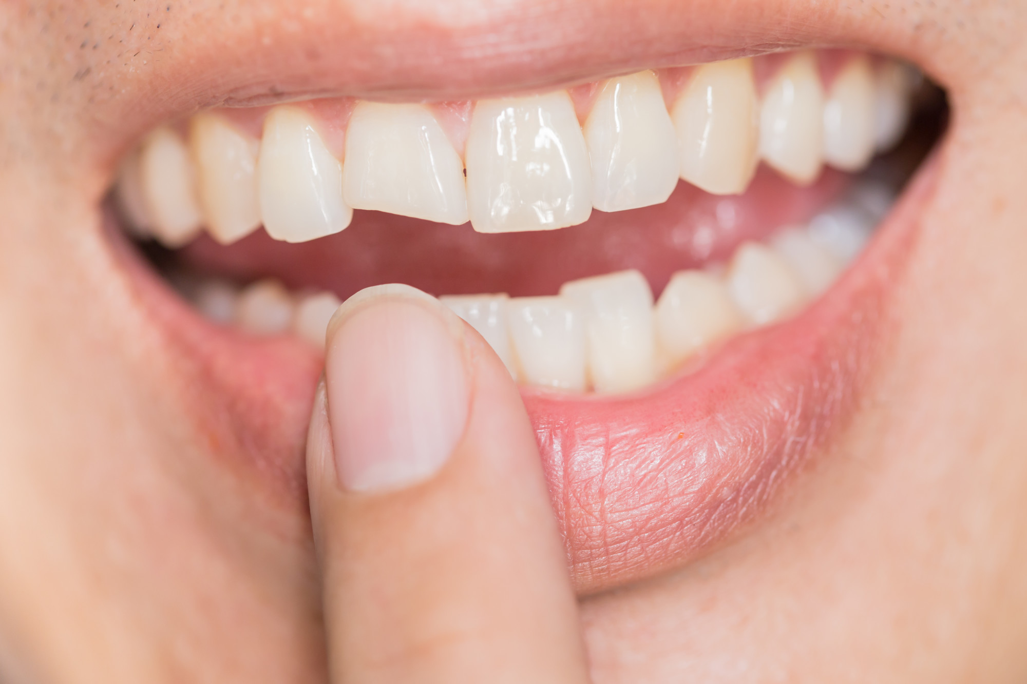 how to fix chipped teeth