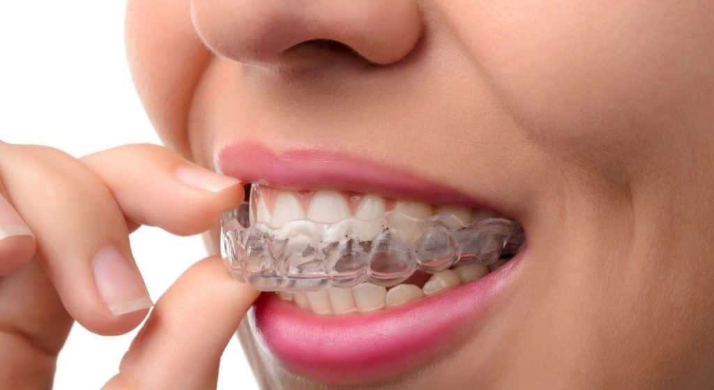 Teeth straightening