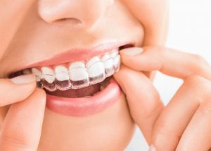 Transparent teeth braces