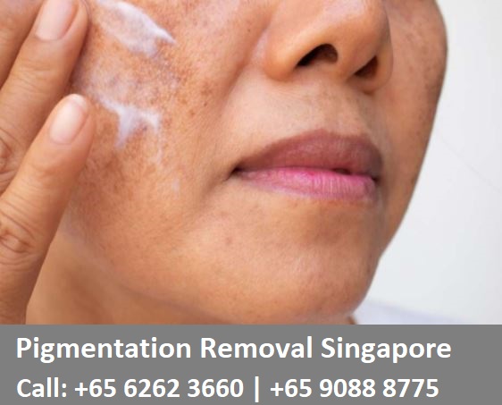 Pigmentation Removal Singapore