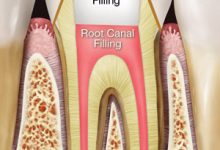 root canal in kharadi