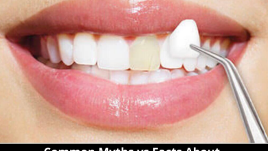 Common Myths vs Facts About Dental Veneers