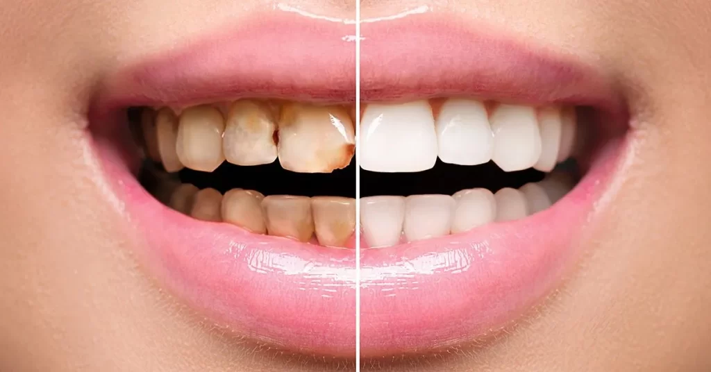 Dental vaneer