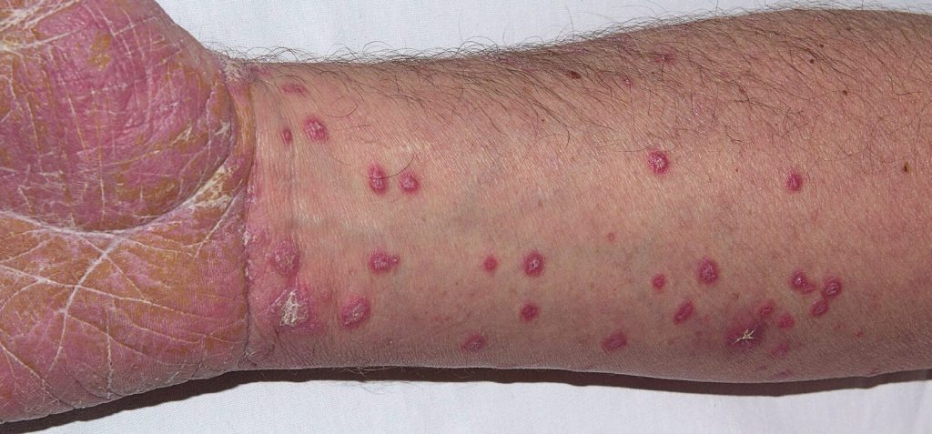 lichen planus