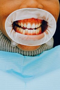 all on four implants
