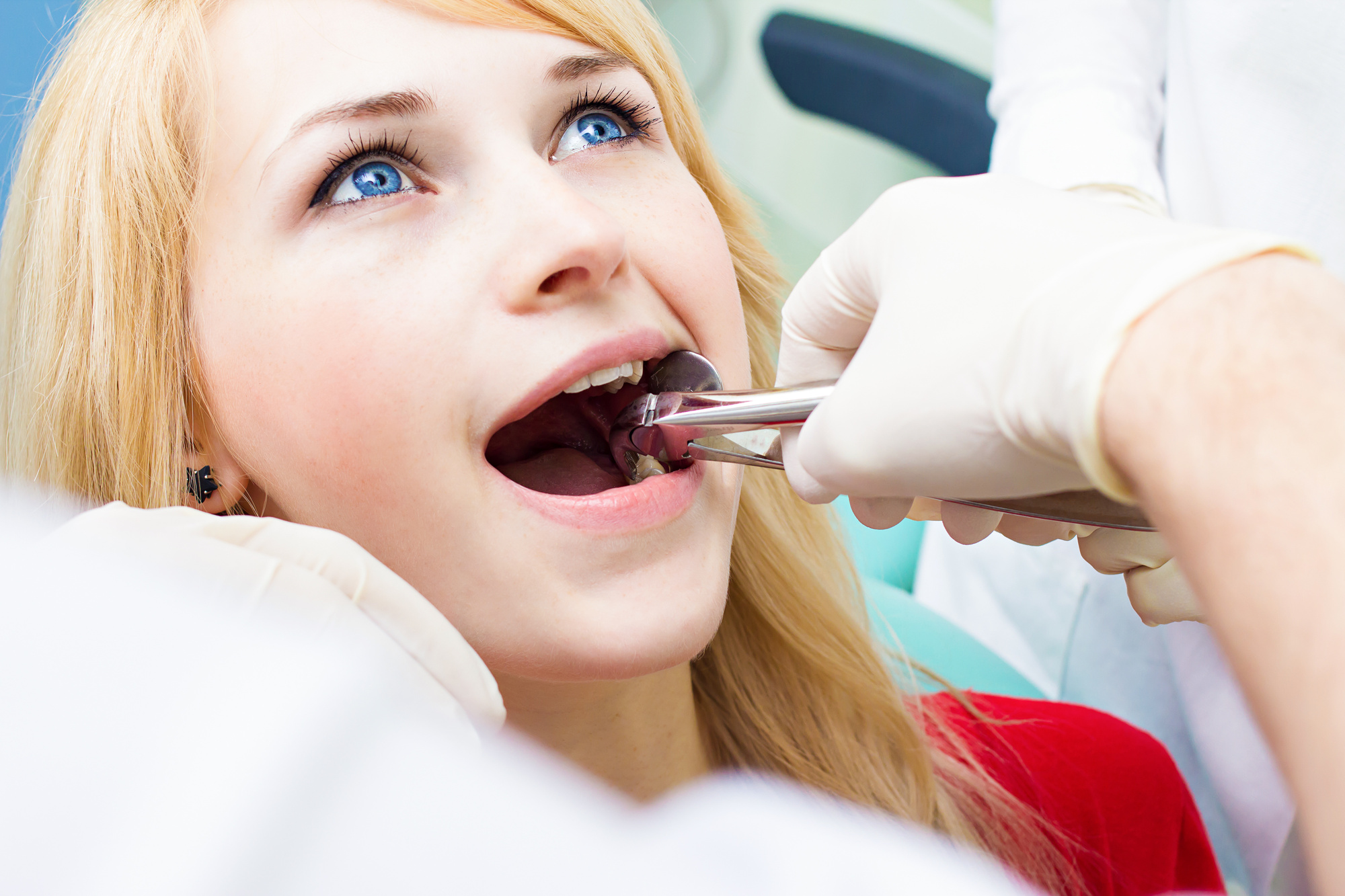 wisdom teeth removal London