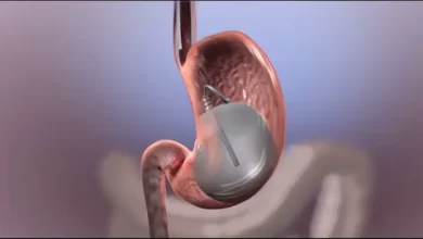Gastric Balloon Cost